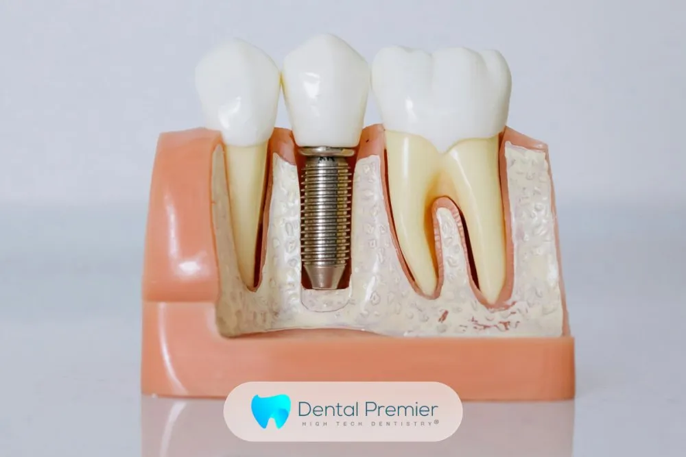 Tehnologii 3D și soluții moderne pentru implanturi dentare la clinica Dental Premier din București!